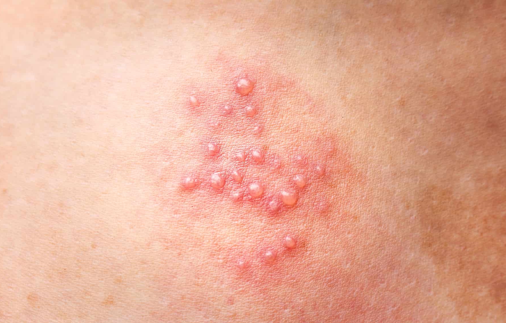 What Does A Herpes Rash Look Like With Pictures